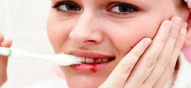 5 Hal yang Dapat Memicu Masalah Gusi Berdarah Pada Gigi