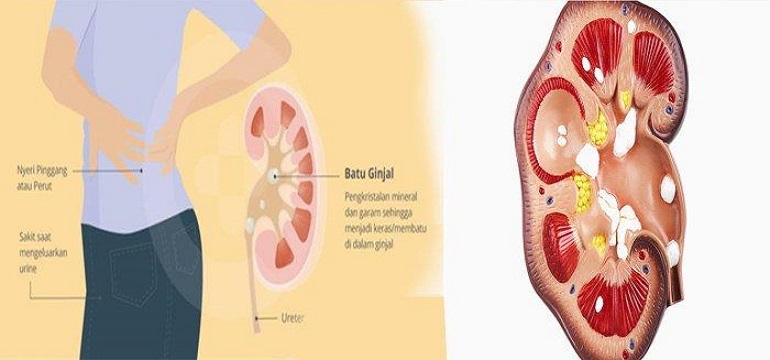 Resep Herbal Hancurkan Batu Ginjal Hingga Tak Tersisa Di Tubuh