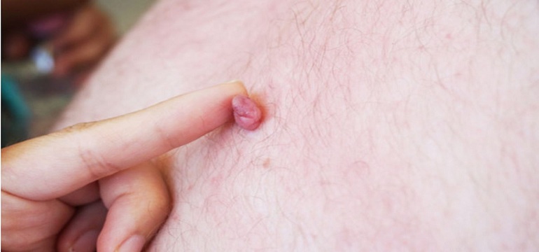 Apa Pengaruh Bagi Kesehatan Jika Memiliki Daging Tumbuh (Skin Tag)