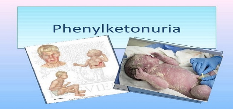 7 Hal Tentang Fenilketonuria Yang Tak Banyak Dipahami Masyarakat