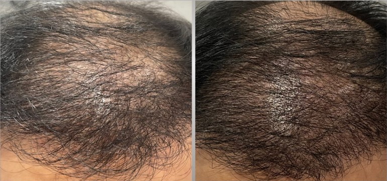 Transplantasi Rambut untuk Menunjang Penampilan